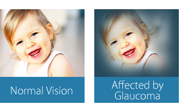Glaucoma Prevention