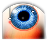 Canaloplasty Eye