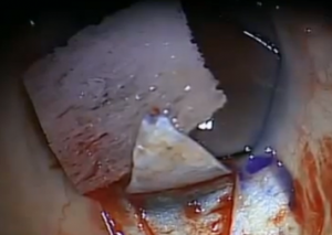 Canaloplasty Glaucoma Surgery Video Series