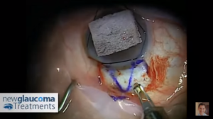 Canaloplasty Glaucoma Surgery Using Mastel Instruments: Part 1 - Dissecting The Superficial Flap