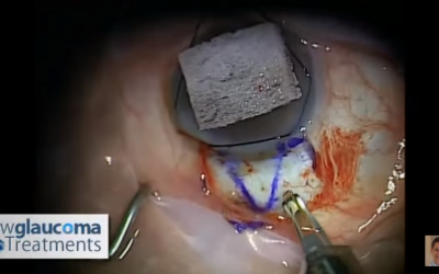 Canaloplasty Glaucoma Surgery Using Mastel Instruments: Part 1 – Dissecting The Superficial Flap
