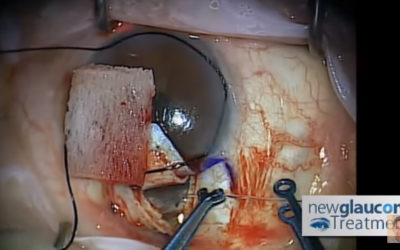 Canaloplasty Glaucoma Surgery Using Mastel Instruments: Part 3 – Catheterization