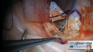 Canaloplasty Glaucoma Surgery Using Mastel Instruments: Part 4 - Suture