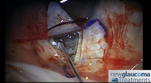 Canaloplasty Glaucoma Surgery Part 4
