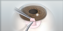 Glaucoma Treatment