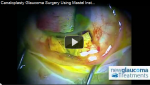 Canaloplasty Glaucoma Surgery with Mastel Series (Part 5)