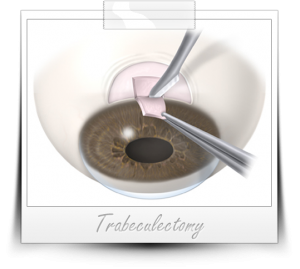 Trabeculectomy