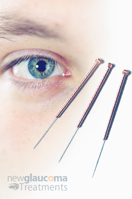 Acupuncture A Natura Treatment For Glaucoma