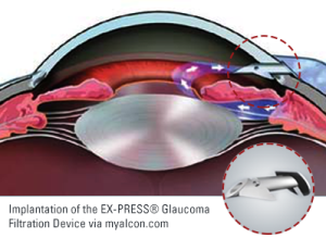 EX-PRESS® Glaucoma Filtration Device