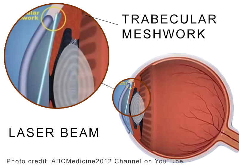 hélice Punto triángulo Introduction To Laser Trabeculoplasty (LT) | New-Glaucoma-Treatments.com