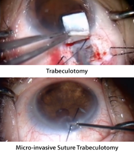 Micro-invasive Suture Trabeculotomy (MIST)