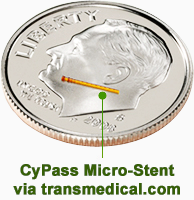 CyPass Micro-Stent® Glaucoma Device