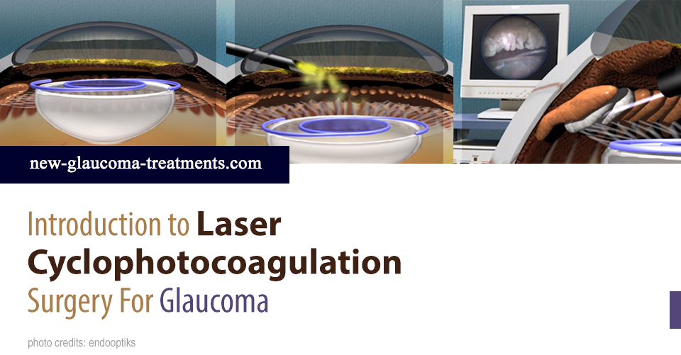Laser Cyclophotocoagulation Surgery For Glaucoma