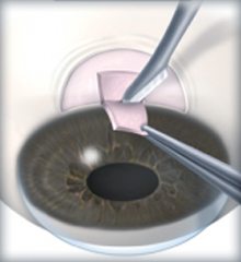 The Evolution of Glaucoma Treatment Surgery