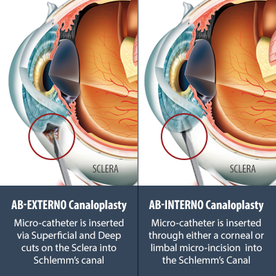 Ab-Interno-versus-Ab-Externo-Canaloplasty