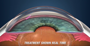 Pattern Scanning Laser Trabeculoplasty (PSLT) Treatment for Glaucoma