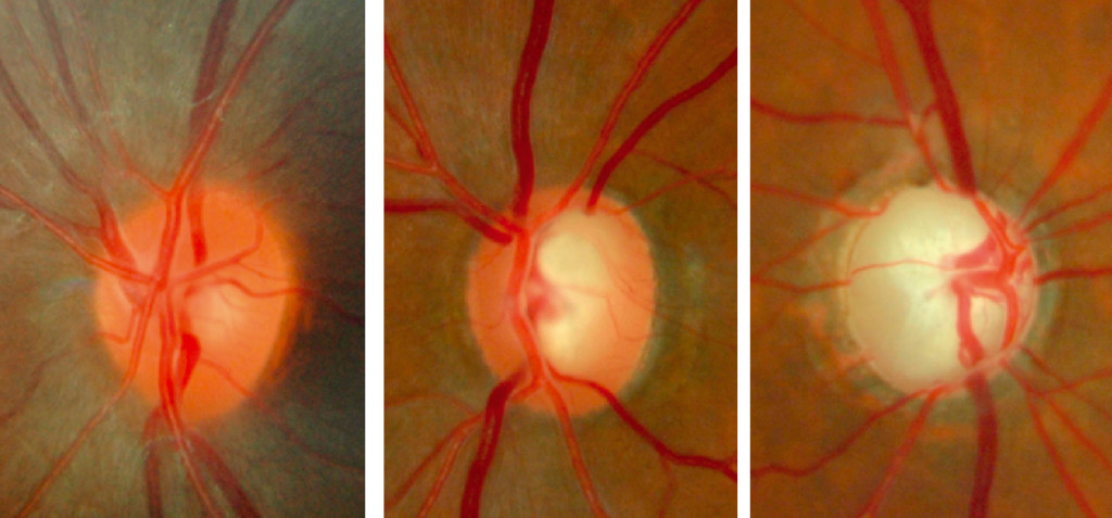 Normal optic disc and glaucomatous optic nerve heads 