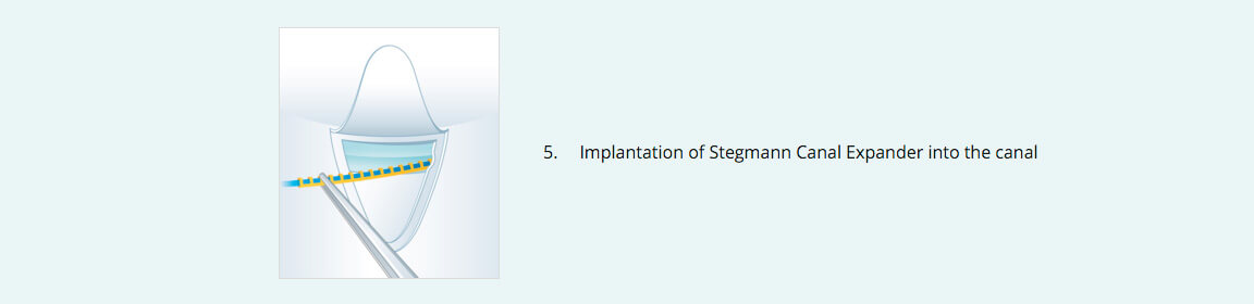 Stegmann Canal Expander® Procedure 5
