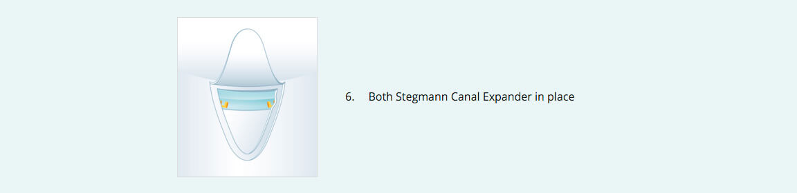 Stegmann Canal Expander® Procedure 6