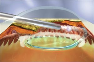 Endoscopic Cyclophotocoagulation (ECP) Glaucoma Surgery Procedure