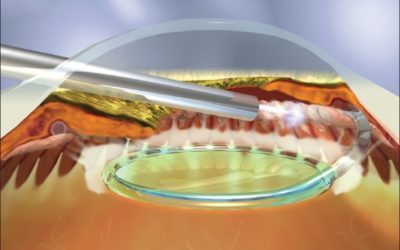 Inflammation after Endoscopic Cyclophotocoagulation (ECP) Glaucoma Surgery