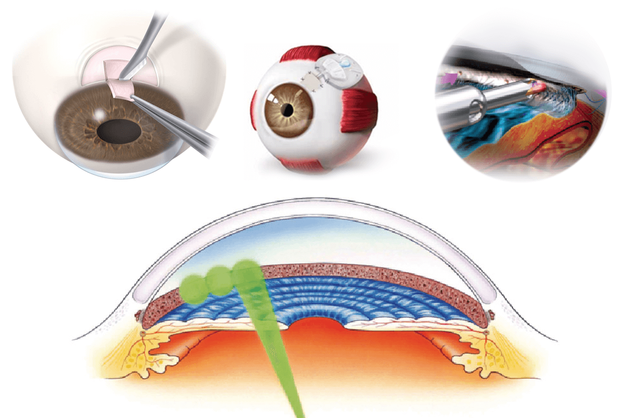 Selective Laser Trabeculoplasty After Incisional Glaucoma Surgery