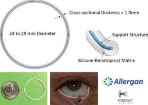 Bimatoprost Ring_Allergan and ForSight