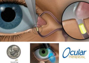 Ocular Therapeutix - Travoprost Plug